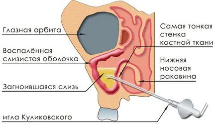 Какво е синузит и как да се лекува
