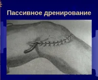 Източване рани - активна и пасивна дренаж