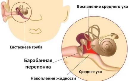 Двустранно лечение на възпаление на средното ухо, и евентуалните последствия