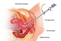 Пролиферативна ендометриума тип стъпка