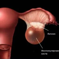 Фоликулярните кисти пречиствателни народни средства за защита на яйчниците