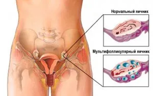 Фоликули в яйчниците, че е