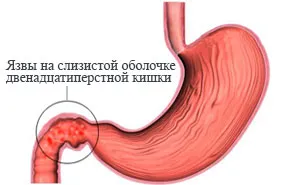 Стомашно симптоми, лечение, диета
