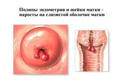 Hyperechoic включвания в матката
