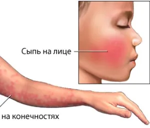 Инфекциозни симптоми зачервяване и лечение за деца и възрастни
