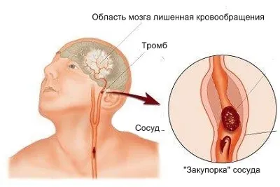 Ход симптоми, симптоми при жените и мъжете, ефектите от