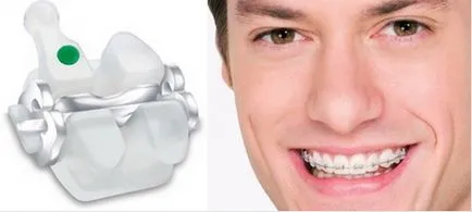Bezligaturnye скоби - удобна корекция захапка