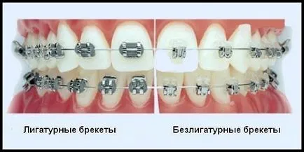 Bezligaturnye скоби - удобна корекция захапка