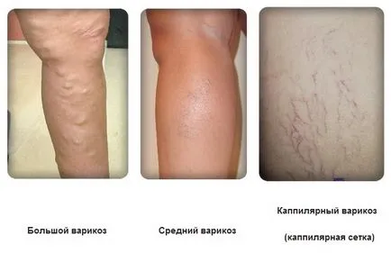Как и какво за лечение на тежки разширени вени на краката на жените и мъжете без операция