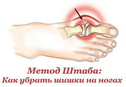 Как да се отървем от натъртвания по краката на народни средства