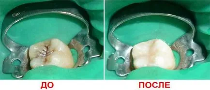 Как за лечение на кариес на различни етапи, стъпала и план за лечение на кариес