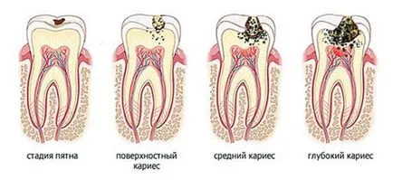 Как за лечение на кариес на различни етапи, стъпала и план за лечение на кариес