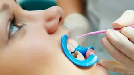 Как за лечение на кариес на различни етапи, стъпала и план за лечение на кариес