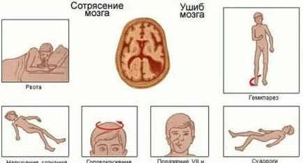 Как да определите сътресение на ранен етап
