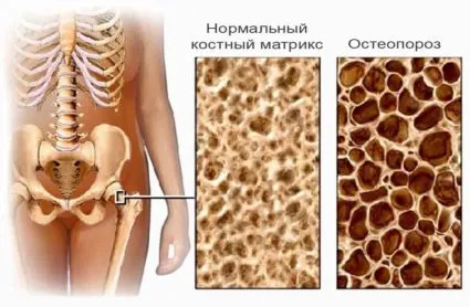 Бифосфонати какво е, как безопасно използването им