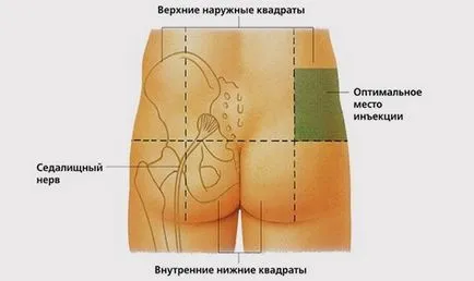 Как да си направим един изстрел в седалищния мускул, мускулни инжекции в къщи, технология