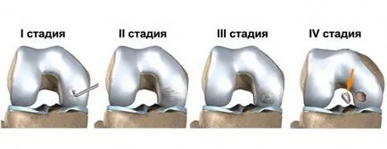Koenig на болестни причини, симптоми, диагностика и лечение (Koenig) болестни Кьониг е причини, симптоми, диагностика и лечение