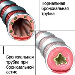 Как да наемете астматичен пристъп у дома народни средства за защита (астма) Как да наемете астматичен пристъп у дома народни средства