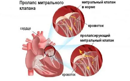 сърдечна клапа не се затваря до края - причини и симптоми