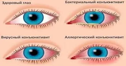 Конюнктивит при възрастни и деца - как да се лекува болестта народни средства
