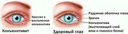 Конюнктивит при възрастни и деца - как да се лекува болестта народни средства