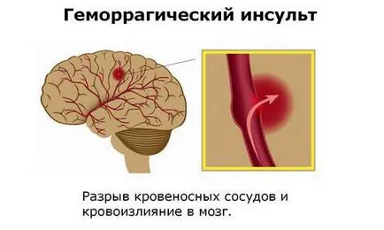 Кома в хеморагичен инсулт