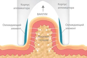 Cryolipolysis как работи този метод, използването на тази процедура в салона и у дома,