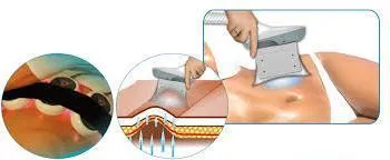 това, указания, противопоказания (козметологията пластична хирургия) Cryolipolysis Cryolipolysis го, показания, противопоказания