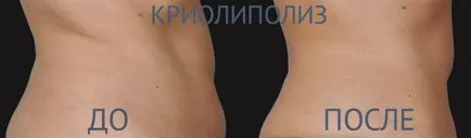 Cryolipolysis - каква е процедурата, преди и след снимки, препоръки