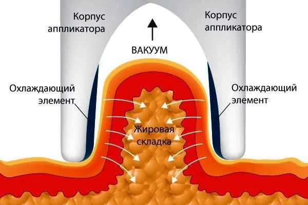Cryolipolysis него показания, противопоказания (cryolipolysis) Cryolipolysis го, показания, противопоказания