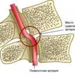 гръбначния херния лазерно лечение