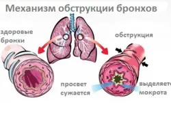 Лечение на обструктивен бронхит народни средства