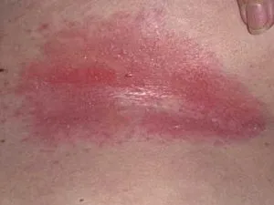 пелена обрив лечение у дома парично изражение