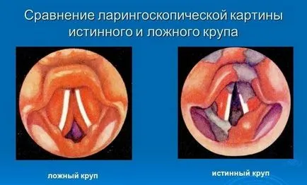 Фалшиви круп в детските симптоми и лечение, оказване на първа помощ в пристъп на фалшива круп
