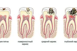 За изплакване на потока на венците