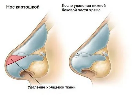 подут носа, ринопластика носа картофи