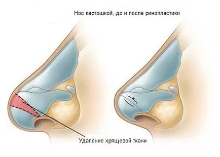подут носа, ринопластика носа картофи