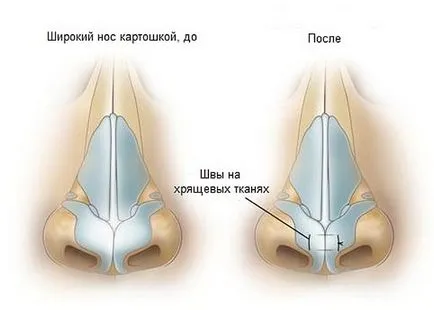 подут носа, ринопластика носа картофи