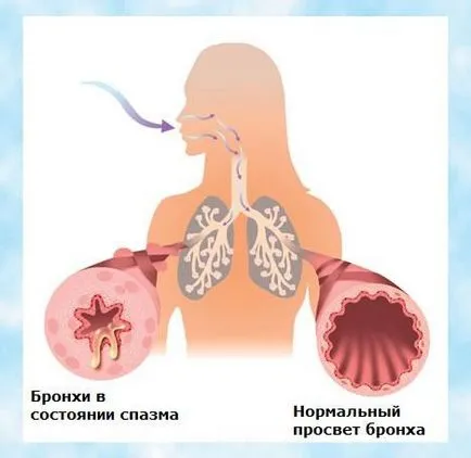 Обструктивен бронхит лечение на народни средства за възрастни и деца