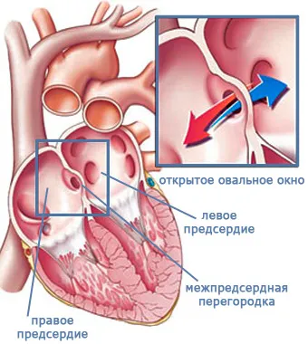 Форамен овале в сърцето на едно дете