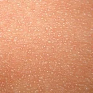 Sudamen деца снимка симптоми и лечение