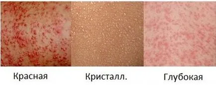 Sudamen деца снимка симптоми и лечение