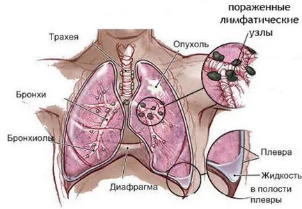 Последният етап от рак симптоми и описание