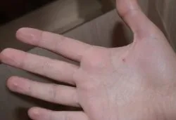 Имаше бенки по пръстите му стойност каузи