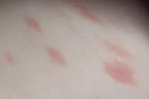 Външният вид на червени петна по кожата причините и лечение на алергии, сърбящи петна защо, снимки