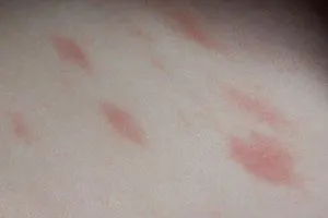 Петната или червени сърбящи - че тя може да бъде (цвят по избор) Петната или червени сърбящи - че тя може да бъде
