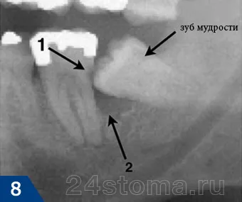 Отглеждане мъдрец - какво да правя, бърза помощ