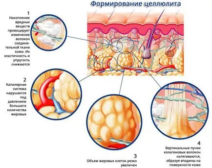 Средства за целулита, причините за (целулит) Средства за целулита, причинява на