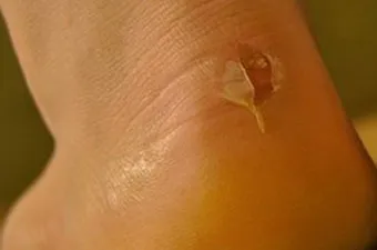 Какво да се направи, че обувките не са триене мазоли на краката си
