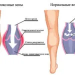 Разширените вени домашно лечение, народни средства